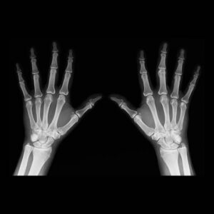 Xray of hands